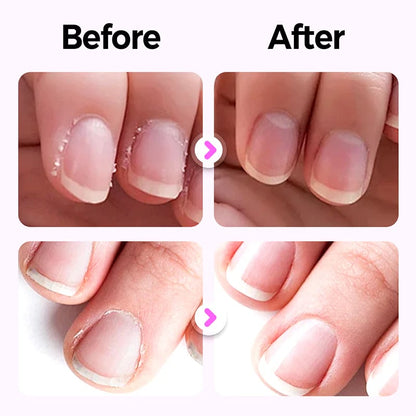 💜Speciellt för manikyr – nagelvårdspenna, reparerar nagelskador orsakade av manikyr